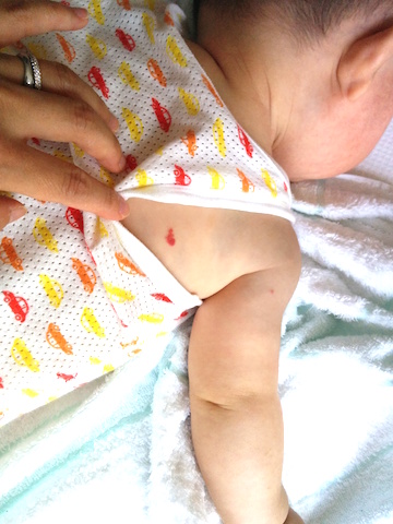 苺状血管腫　いちご　イチゴ　赤ちゃん　6ヶ月　1歳　背中　あざ　アザ　いぼ　イボ　赤い